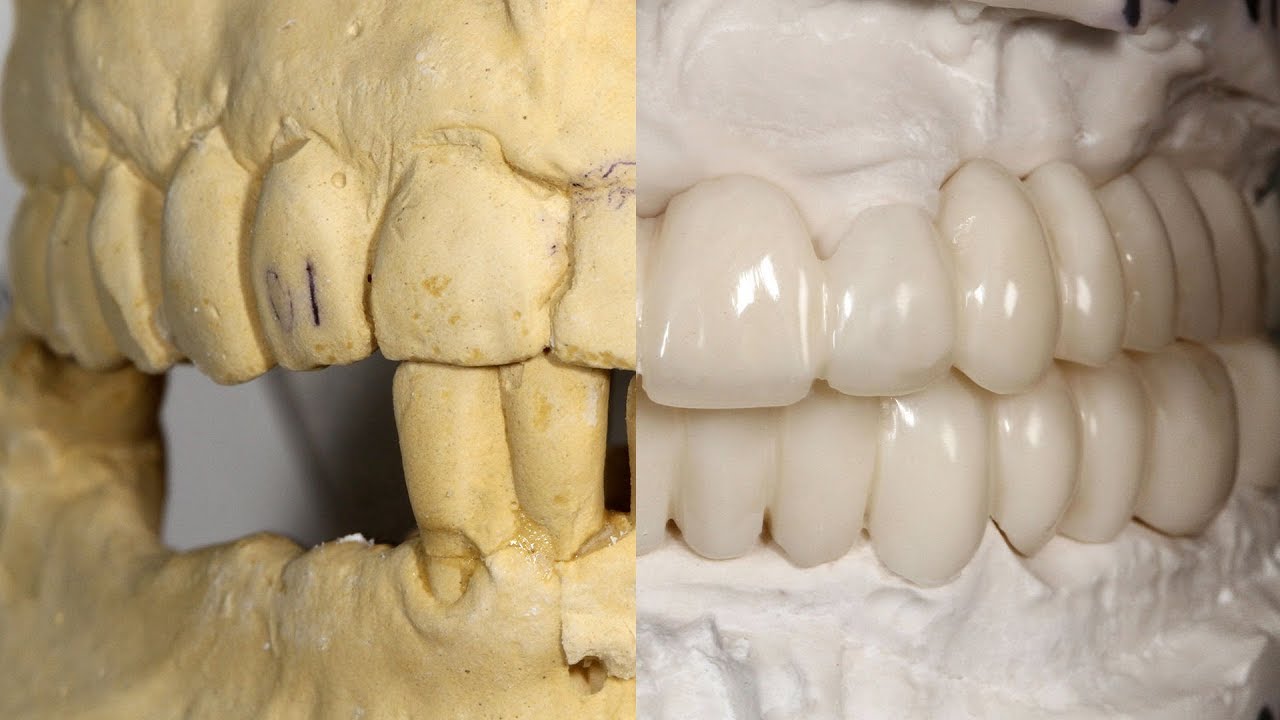 How To Make An Analog Temporary Prosthesis YouTube