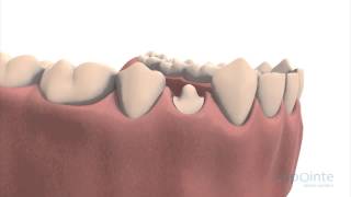 Reconstruction in anticipation of a crown - Lapointe dental centres