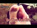 Most Popular Dr Nail Nipper Video.  Doing a Pus Pop [Throwback Thursday]