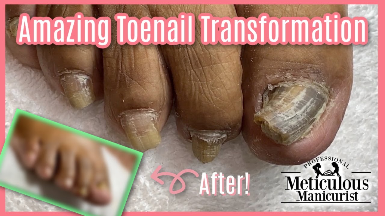 Pedicure Transformation on Thick Impacted Toenails RIGHT FOOT YouTube