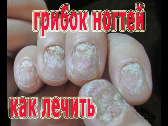 ★Как ЛЕЧИТЬ ГРИБОК НОГТЕЙ народными способами. Лечение Онихомикоза уксусом и хреном.