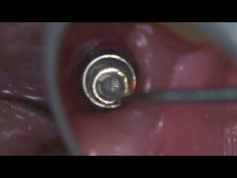 Dental Implant Broken