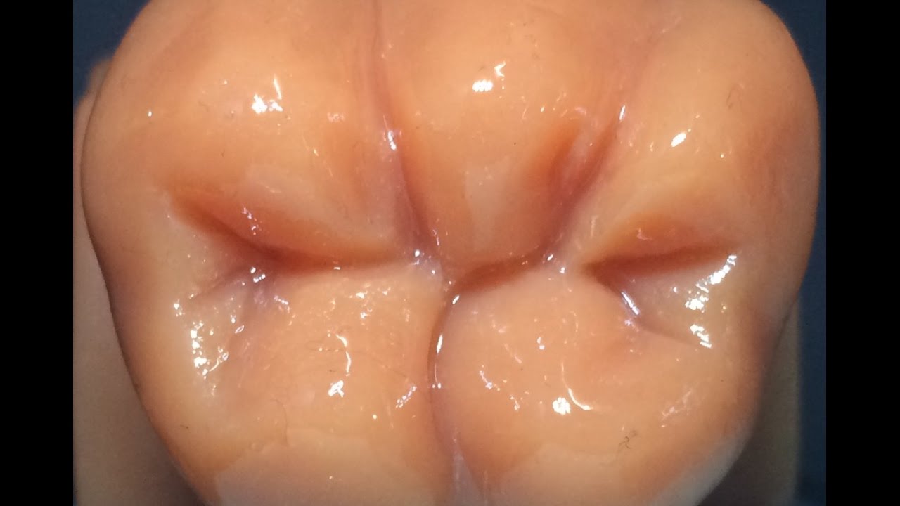 Carving occlusal surface of lower 6 ( MANDIBULAR FIRST MOLAR )