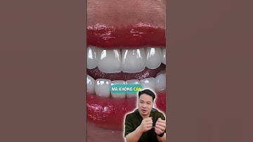 Răng thẩm mỹ – Tỏa sáng tự nhiên, cuốn hút từ nụ cười #drThu #BsThu #Dansuthammy #Veneer