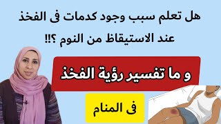 ما سبب ظهور كدمات على الجسم بعد الاستيقاظ من النوم ؟ و ما تفسير رؤية الفخ فى المنام ؟ | نهال مجدى