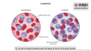 Apml स जदग क जग जत ल Real Cancer Survivor Story Positron Hospital Cancer Hospital
