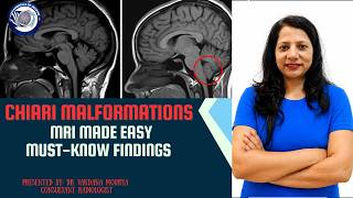 Chiari Malformation MRI Findings You Must Know