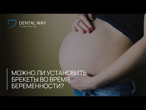 Можно ли установить брекеты во время беременности  ?