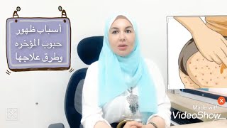 الحل النهائى لعلاج حبوب المؤخره