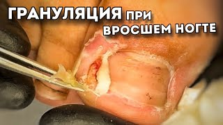 Дикое мясо бокового валика. Коррекция вросшего ногтя
