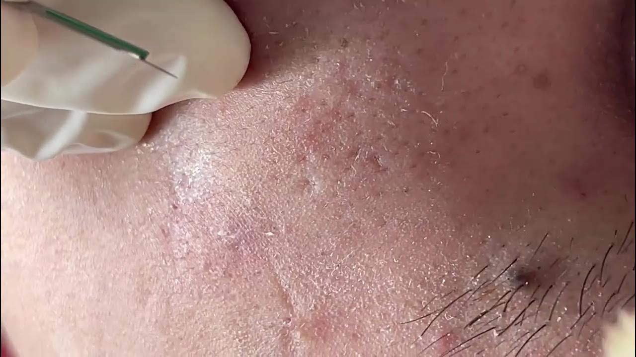 ACNE TREATMENT MAI NGOC - YouTube