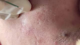 Blackheads and whiteheads on cheeks - ACNE TREATMENT MAI NGOC