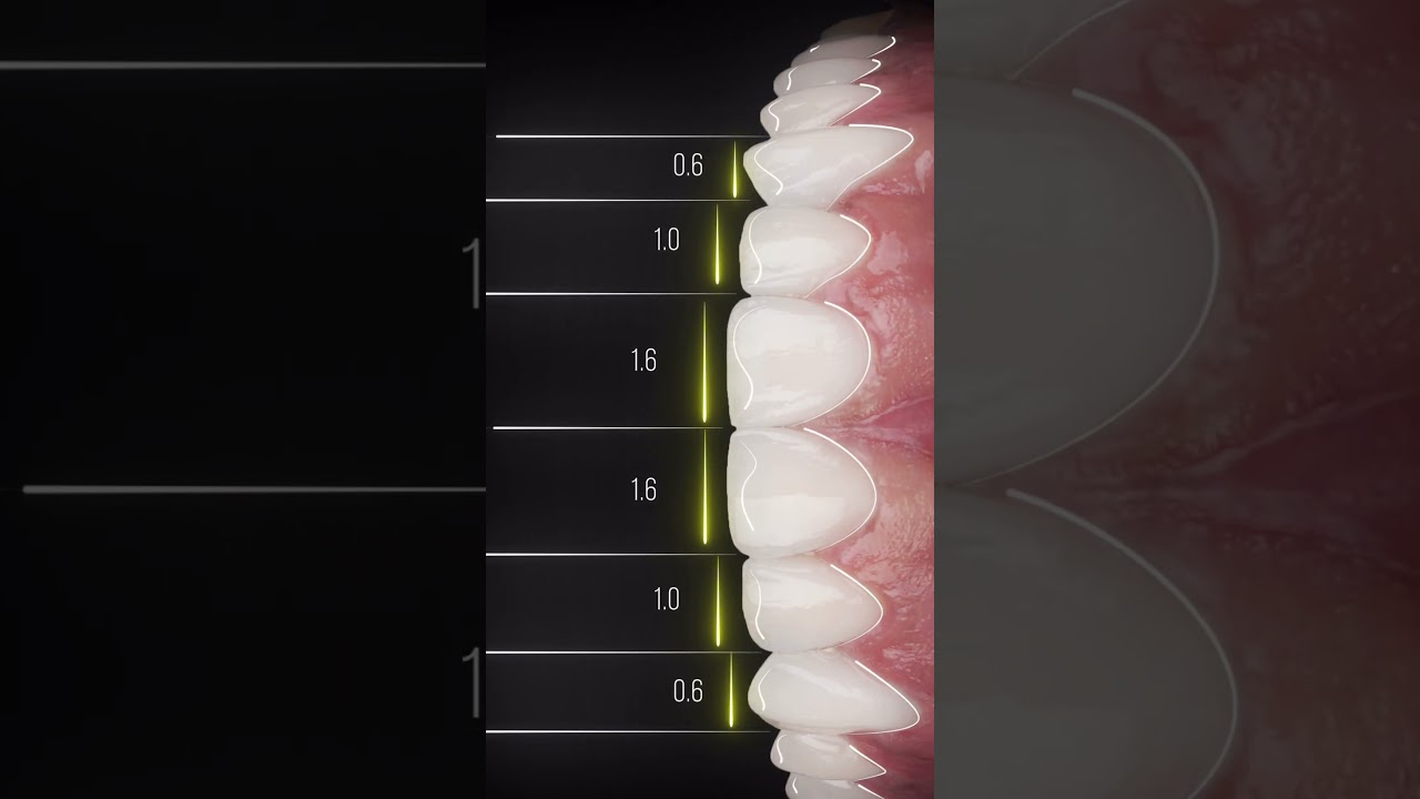 What REAL Professional Veneers Look Like!