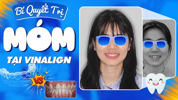 Bí Quyết Trị Khớp Cắn Ngược Tại Vinalign| Chỉnh Răng Class III Bằng Khay Vinalign | Nam Bui Vinalign