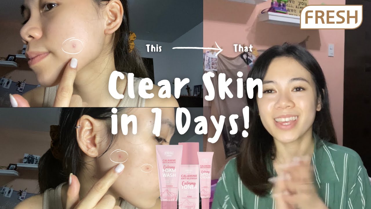 fresh calamine anti blemish