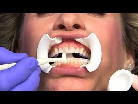Lumineers® Placement Step-by-Step - DenMat Dental Education