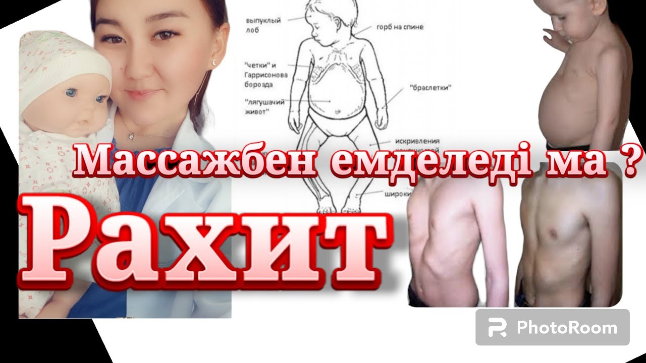 Рахит | клиникасы | этиологиясы | емі #рек. #баламассажы #сәбикүтімі