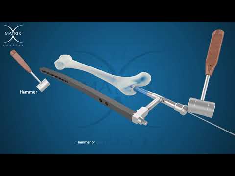 Surgical Technique Femur Interlocking Nail Matrix Meditec