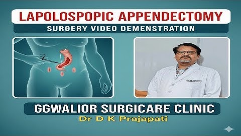 Laparoscopic Appendectomy for Perforated Appendix.  🎈🎈#appendicitis #laparoscopysurgery. #acutepain