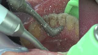Clinical video: Powder polishing Prophy-Mate neo