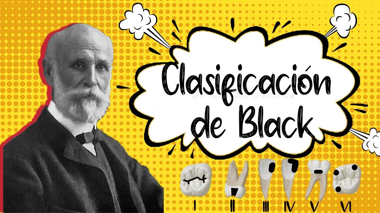 🦷CLASIFICACIÓN DE BLACK ODONTOLOGÍA FÁCIL Y BIEN EXPLICADA!!! Guía  Definitiva