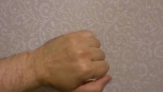 Dupuytren&#39;s contracture , Контрактура Дюпюитрена 2 часть.