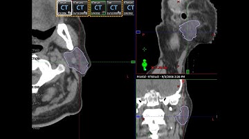Eclipse Contouring Series: Parotid Gland