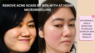 How to Get Rid of Acne Scars Without Spending A fortune With At Home Treatment by Naomi Natalie  115 views 1 year ago 9 minutes, 58 seconds