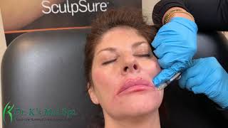 Lip, Cheeks, and Chin Dermal Filler Injection | Dr. K's Med Spa