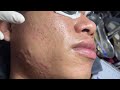 Acne treatment huong da nang601  2024  blackheads