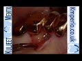 Periodontal Surgery with M MIST-Upper right molar.