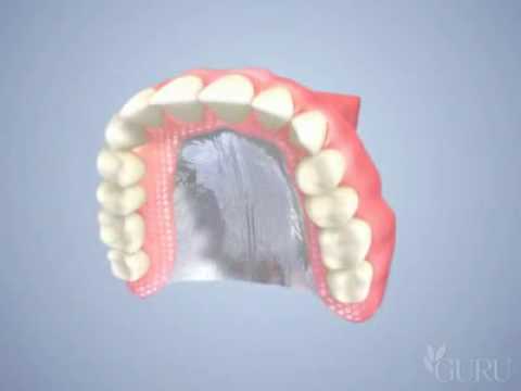 Prothèse dentaire complète amovible (dentier) - Centres dentaires