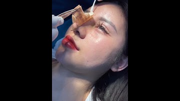 Tháo nẹp mũi và cắt chỉ sau 10 ngày nâng mũi cấu trúc.