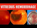 Vitreous hemorrhage  everything you need to know