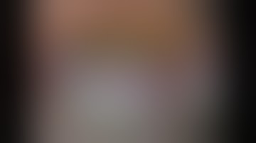 Phaco in Phacolytic Glaucoma using Hydrophobic IOL as scaffold #Phaco #glaucoma #surgery