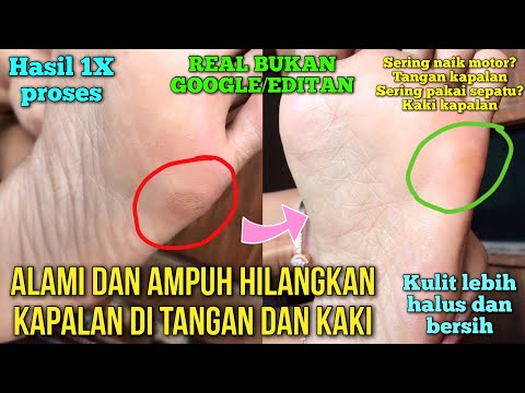 Video: Kalus (kapalan Kering) Pada Jari Kaki, Tumit, Kaki, Telapak Kaki - Sebab, Gejala Dan Penghapusan Kapalan Pada Kaki