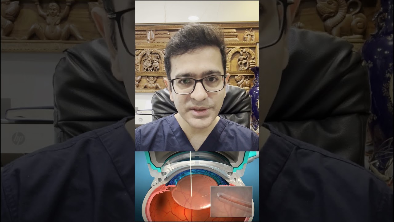 Laser Cataract Surgery vs Traditional – Watch Before Your Surgery!