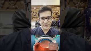 Laser Cataract Surgery vs Traditional – Watch Before Your Surgery!