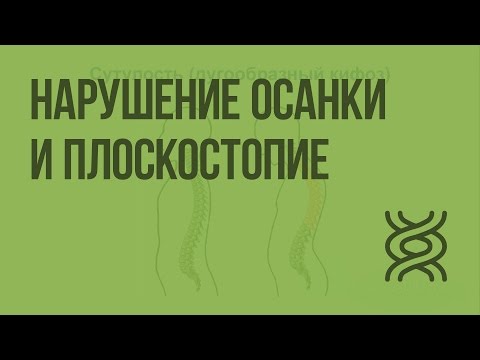 Нарушение осанки и плоскостопие. Видеоурок по биологии 8 класс