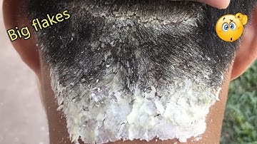 Dandruff Scratching - Itchy Dry Scalp Treatment #593 (BIG FLAKES)