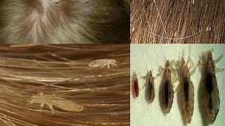 علاج القمل والصيبان نهائيا وصفة طبيعية لعلاج قمل الرأس والصيبان في الشعر من الاستعمال الأول