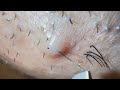 Plucking facial hair & ingrown hair 1262 頬髭抜き(埋没毛あり)