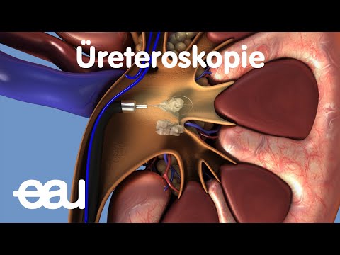 Tedavi böbrek ve üreteral taşlari: Üreteroskopi (URS)