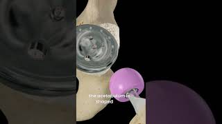 Hip replacement 