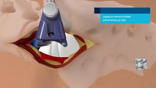 OLIF51 Procedure Oblique Lateral Interbody Fusion 51 - Dr. Ayman Nashashibi - د. أيمن النشاشيبي Oblique Lateral Lumbar Interbody Fusion Ollif