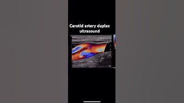 Carotid artery, duplex, ultrasound, image, video