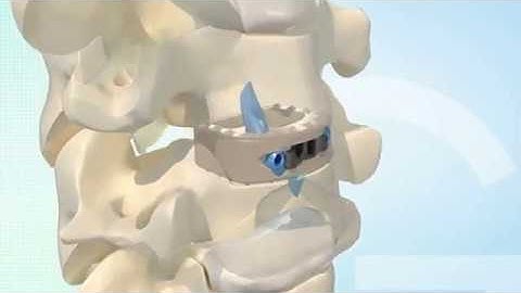 Genesys Spine: AIS C Stand Alone Inserter