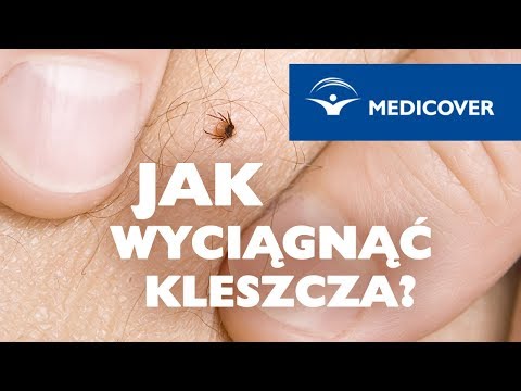 Wideo: Jak Usunąć Kleszcza, Jeśli Ssał?