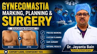 Gynecomastia Surgery | Marking, Planning & Surgery | Dr. Jayanta Bain Plastic Surgeon