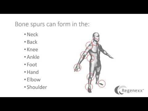 What is a Bone Spur?